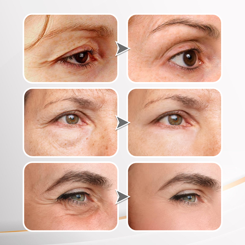 🔥 Last Day Discount: 50% OFF💐Instant Wrinkle Eye Tightener cream